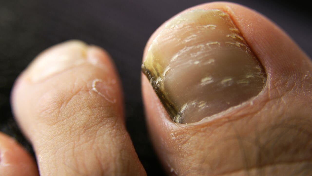 10 remedios caseros para los hongos en las uñas de los pies